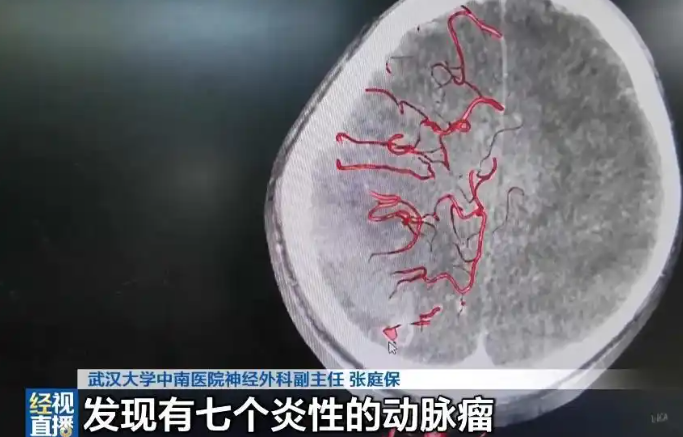 10岁男孩徒手拔烂牙,几个月后突发大量脑出血!医生:口腔感染入血,一路侵袭心脏瓣膜,攻入大脑……紧急提醒(图1) 10岁男孩徒手拔烂牙,几个月后突发大量脑出血!医生:口腔感染入血,一路侵袭心脏瓣膜,攻入大脑……紧急提醒(图1)